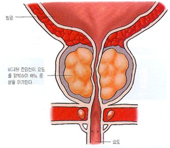 전립선, 방광염 치료 선구자 일중한의원 :: [전립선염] 전립선염이란 ...